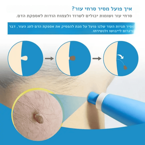 SEFUDUN – ערכת הסרת סרחי עור, שומות ופלולות אוטומטית | ערכת הסרת סרחי עור, שומות ופלולות אוטומטית | אוזו - שופ